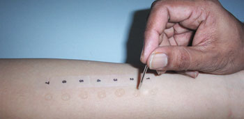 Skin prick test